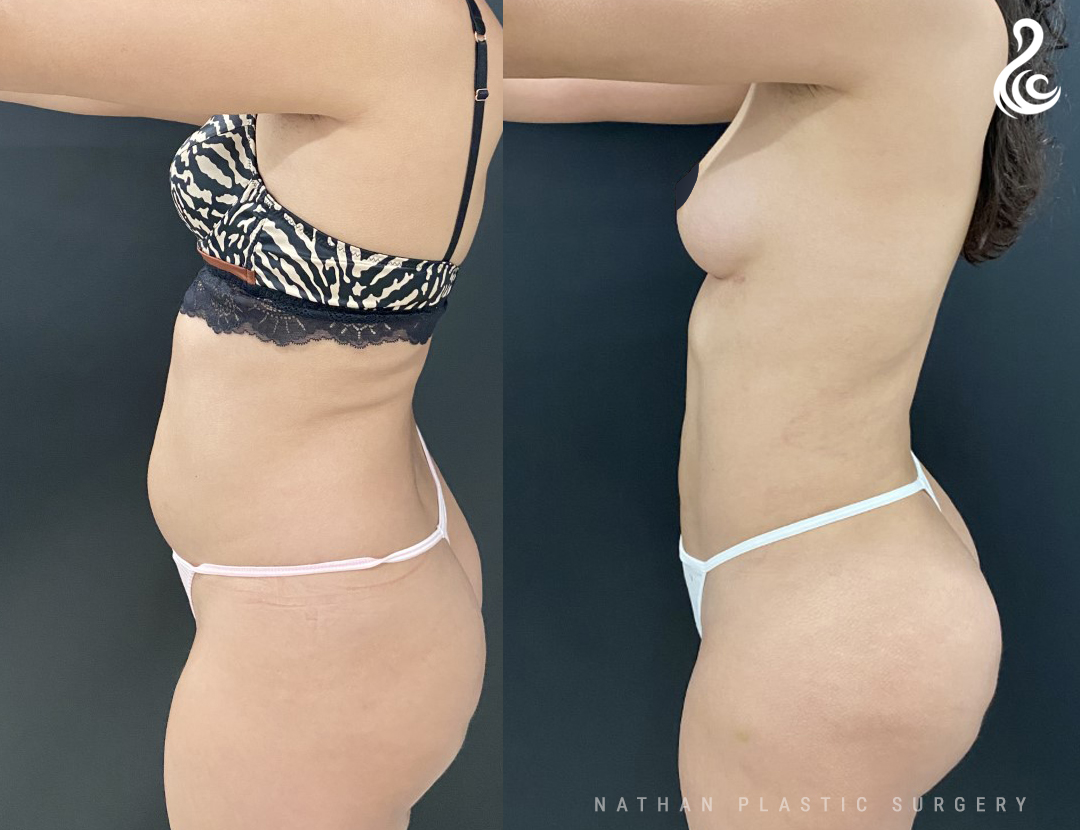 Flanks Fat Reduction In Miami