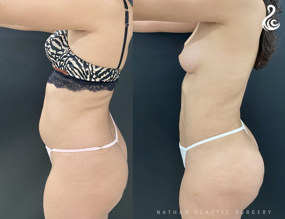 Abdominal Etching  South Florida Center for Cosmetic Surgery