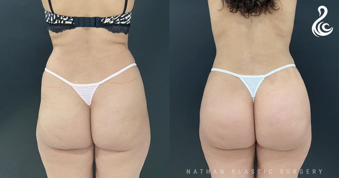 BBL Brazilian Butt Lift Before & After Photos - Dr. Nirmal Nathan