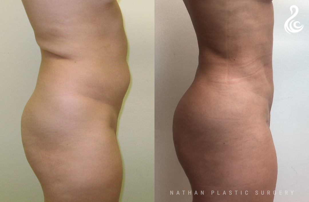 Taking Control of Your Body Contours With Liposuction High Point, NC
