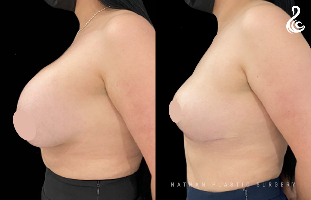 Breast Implant Removal with Fat Transfer