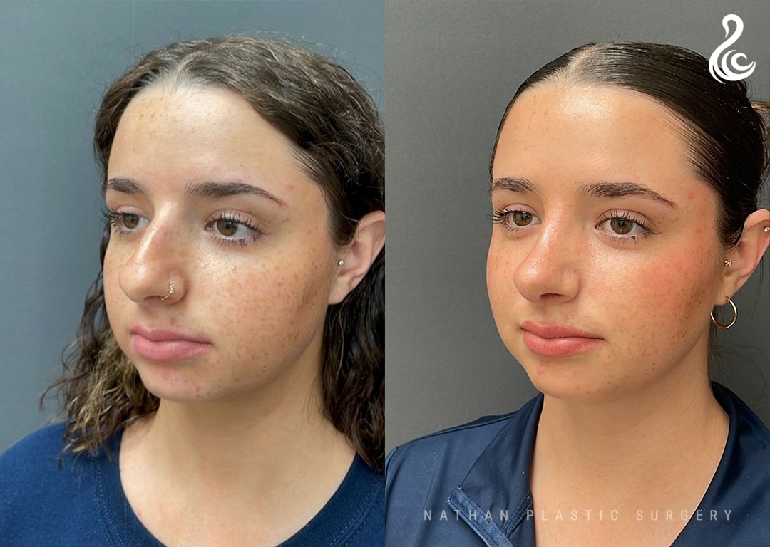 Rhinoplasty (Nose Job) Before and After Photo. Rhinoplasty performed at The Nathan Clinic in Miami, FL.