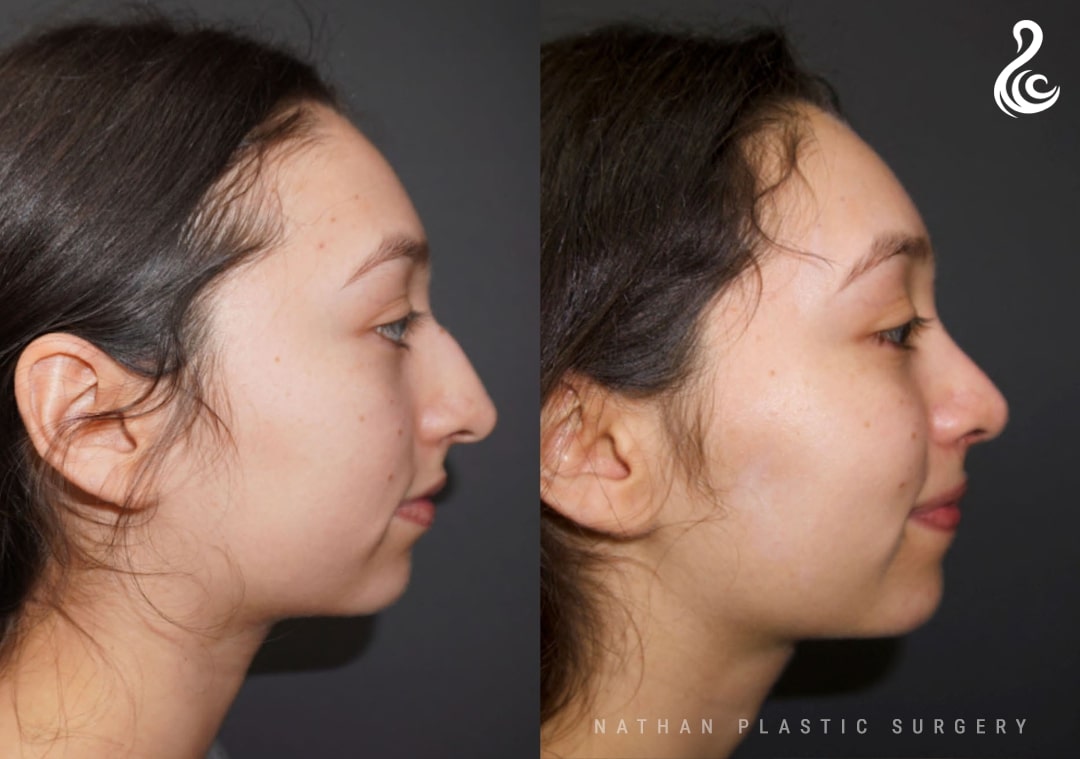 Rhinoplasty (Nose Job) Before and After Photo. Rhinoplasty performed by Dr. Nathan in Miami, FL.