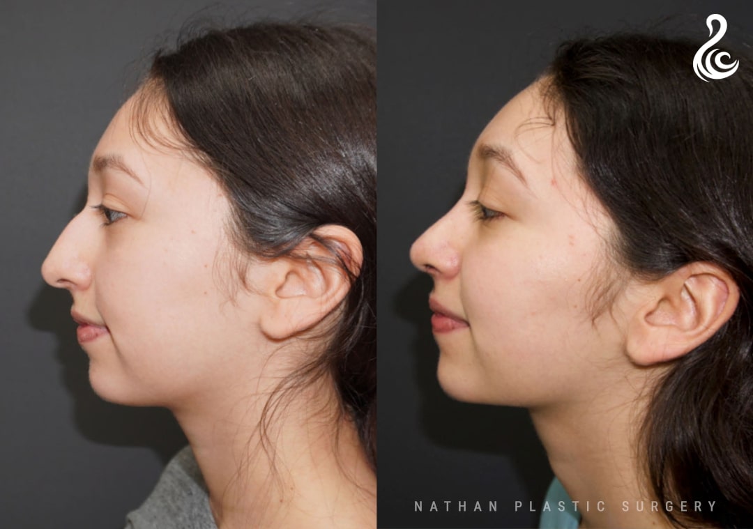 Rhinoplasty (Nose Job) Before and After Photo. Rhinoplasty performed by Dr. Nathan in Miami, FL.
