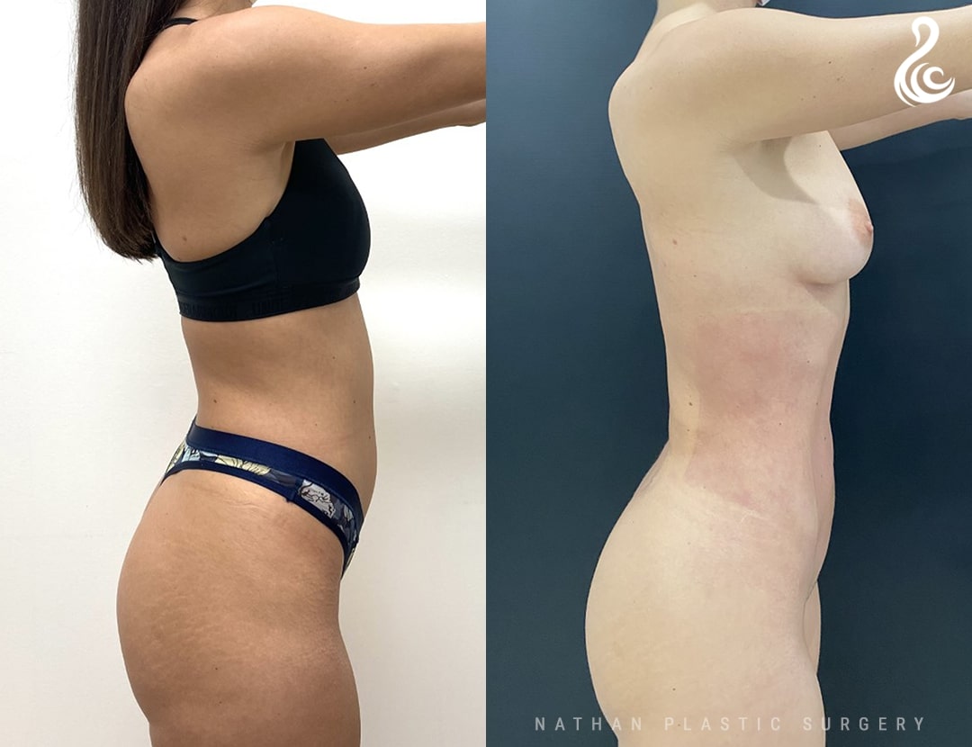 Liposuction Before & After Photos - Dr. Nirmal Nathan