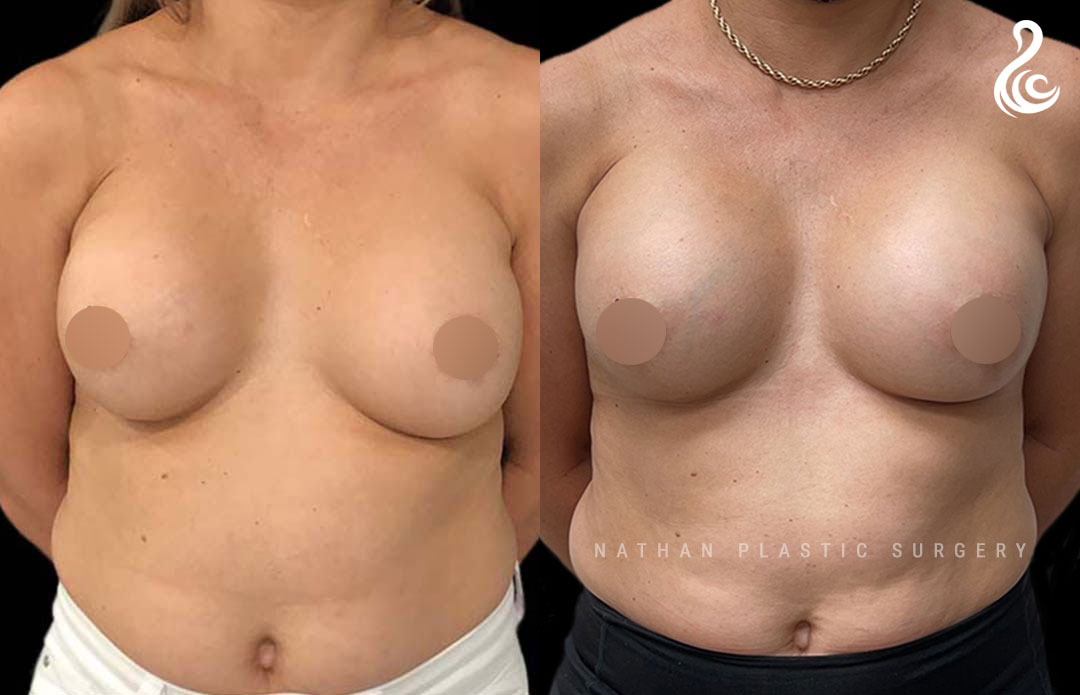 Breast Implant Revision Before and After Photo. Breast Revision by Dr. Nirmal Nathan in Miami, FL.