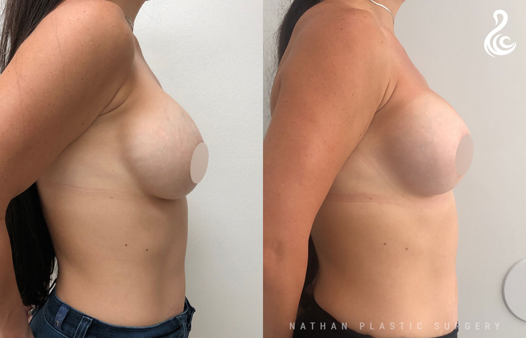 Breast Implant Revision Before and After Photo. Breast Revision by Dr. Nirmal Nathan in Miami, FL.