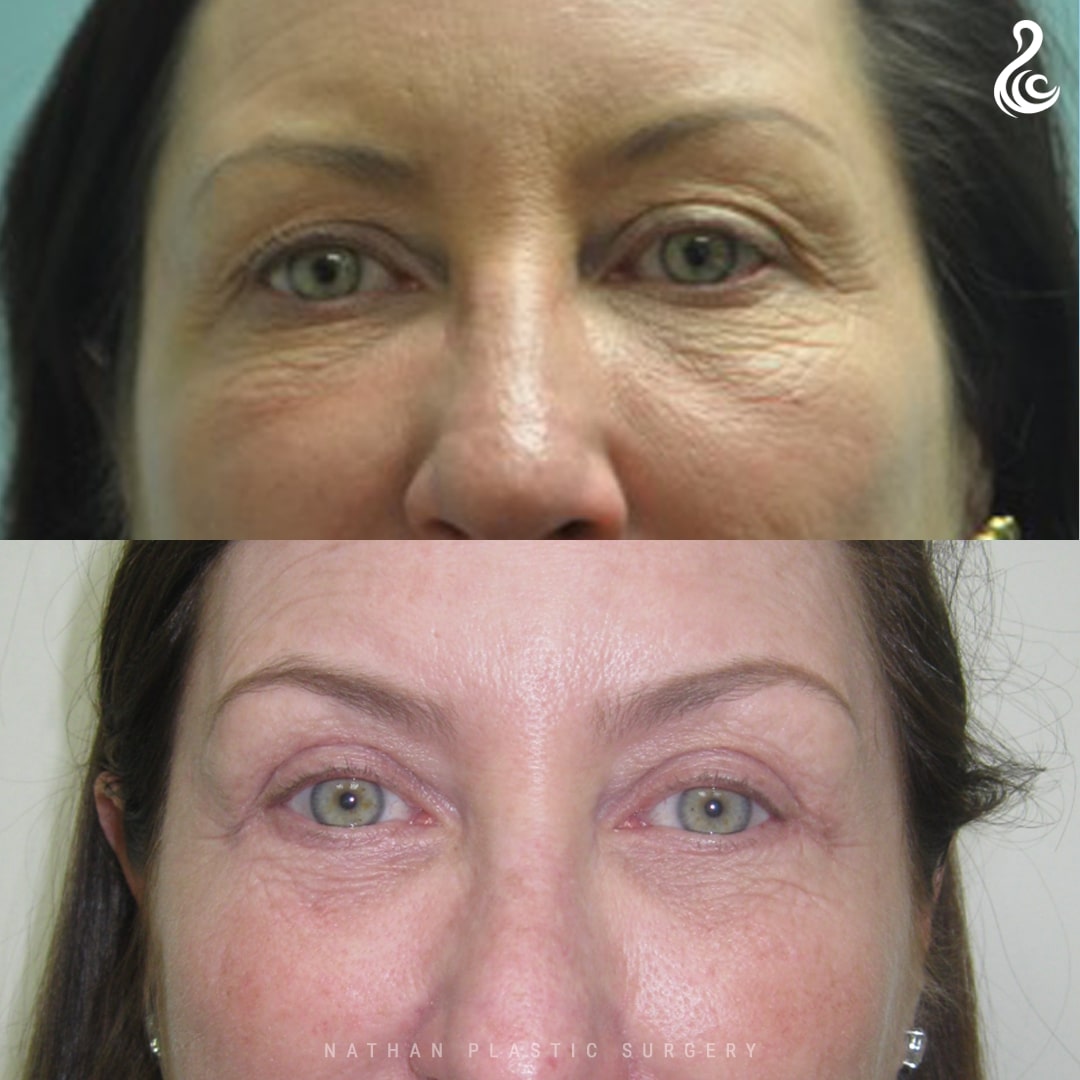 Eyelid Surgery (Blepharoplasty) Before and After Photo. Surgery by Dr. Nirmal Nathan in Miami, FL.