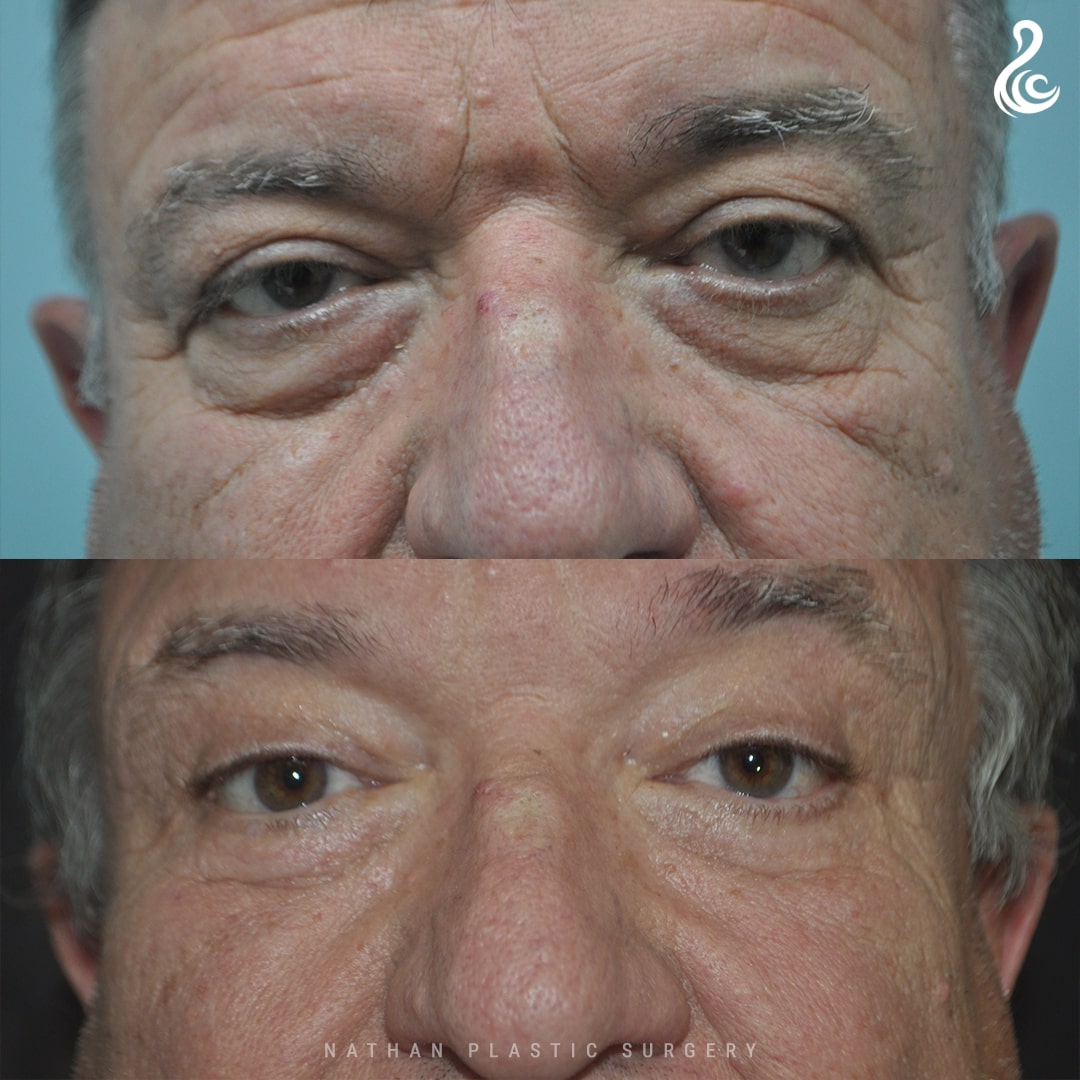 Eyelid Surgery (Blepharoplasty) Before and After Photo. Surgery by Dr. Nirmal Nathan in Miami, FL.