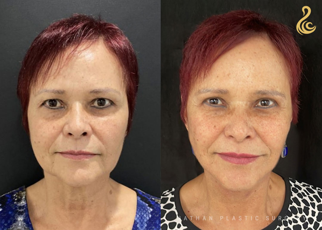 Facelift Before and After Photo. Facelift performed by Dr. Nathan in Miami, FL.