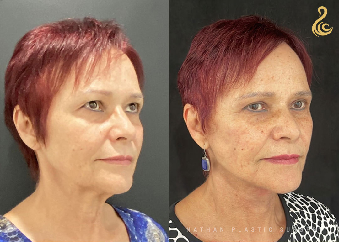 Facelift Before and After Photo. Facelift performed by Dr. Nathan in Miami, FL.