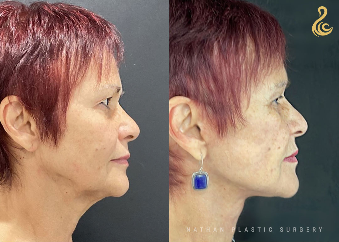 Facelift Before and After Photo. Facelift performed by Dr. Nathan in Miami, FL.