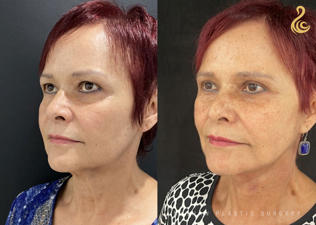 Facelift Before and After Photo. Facelift performed by Dr. Nathan in Miami, FL.