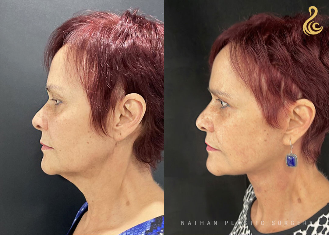 Facelift Before and After Photo. Facelift performed by Dr. Nathan in Miami, FL.