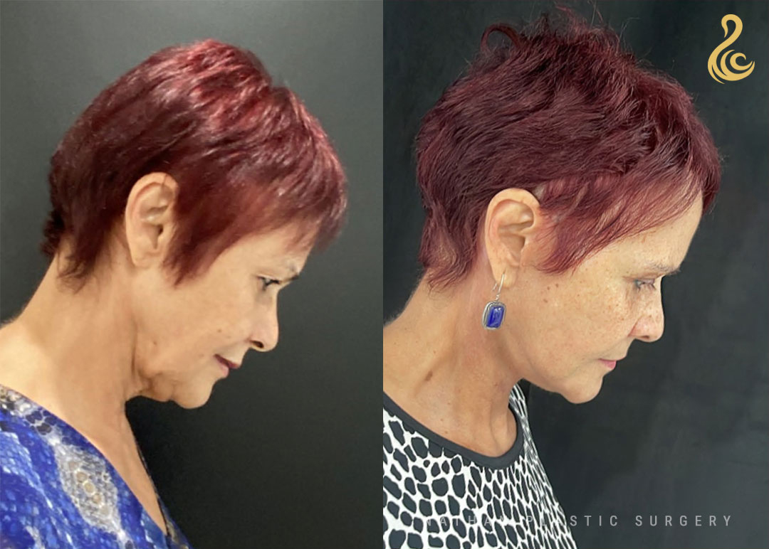 Facelift Before and After Photo. Facelift performed by Dr. Nathan in Miami, FL.