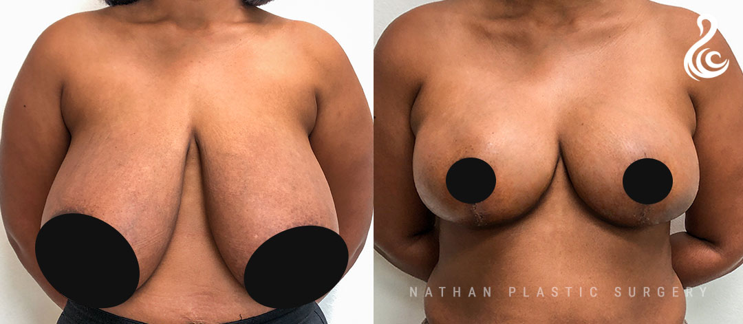 Breast Reduction Before & After Photos